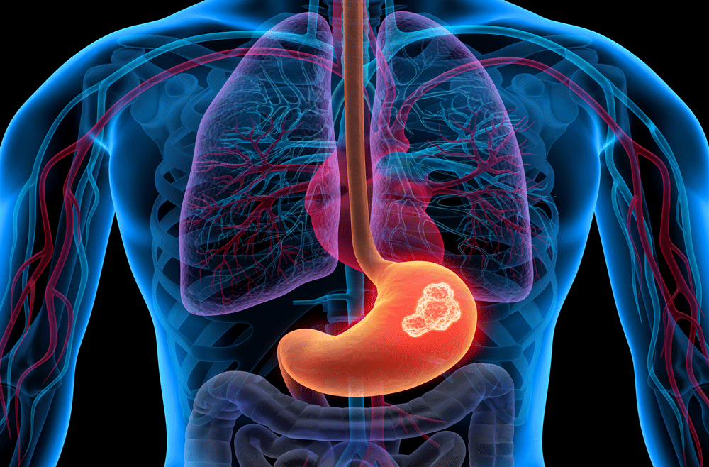 Stomach (Gastric) Cancer Abramson Cancer Center Penn